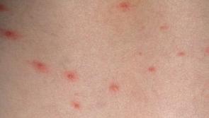 Chickenpox vaccination could be added to childhood immunisation schedule