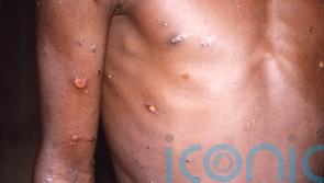 No monkeypox cases in Ireland or NI despite dozens across UK and Europe