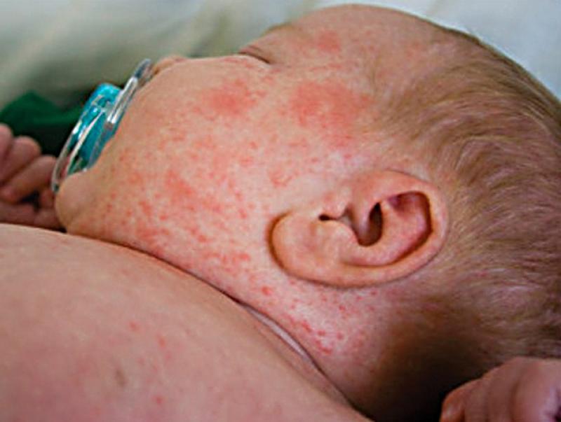 rash-measles-infant