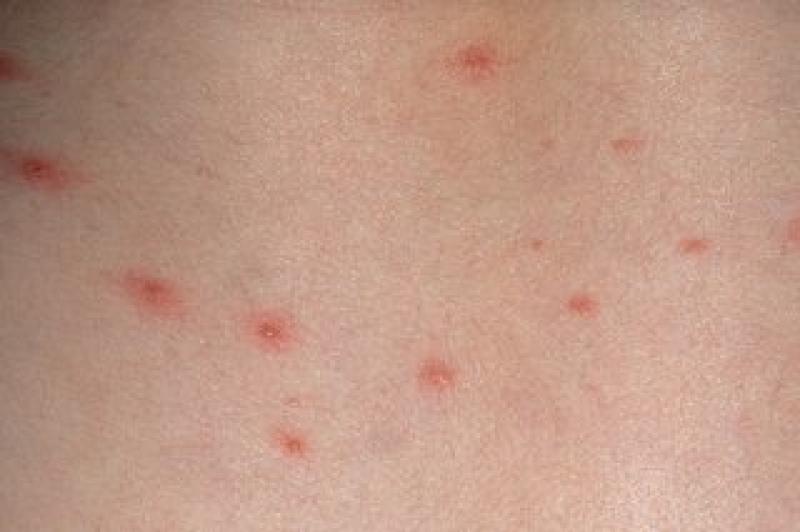 Chickenpox vaccination could be added to childhood immunisation schedule