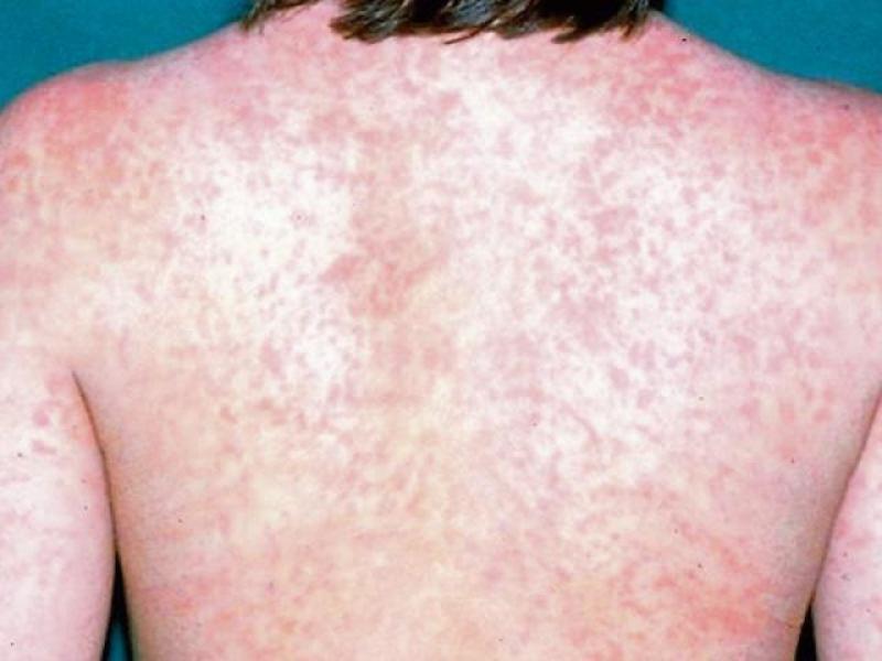 Fourth case of measles confirmed in Ireland amid HSE alert