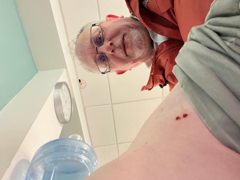 TD bitten by dog while out canvassing for election shares update